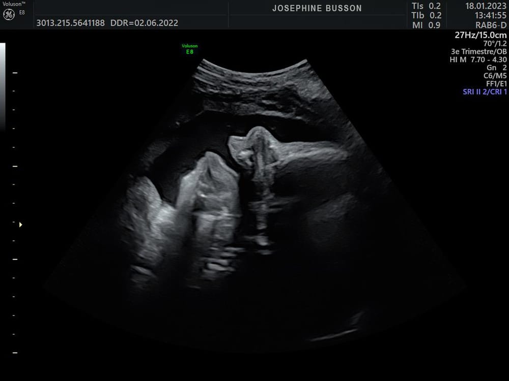 Échographie du 3e trimestre : visage du bébé, bouche ouverte